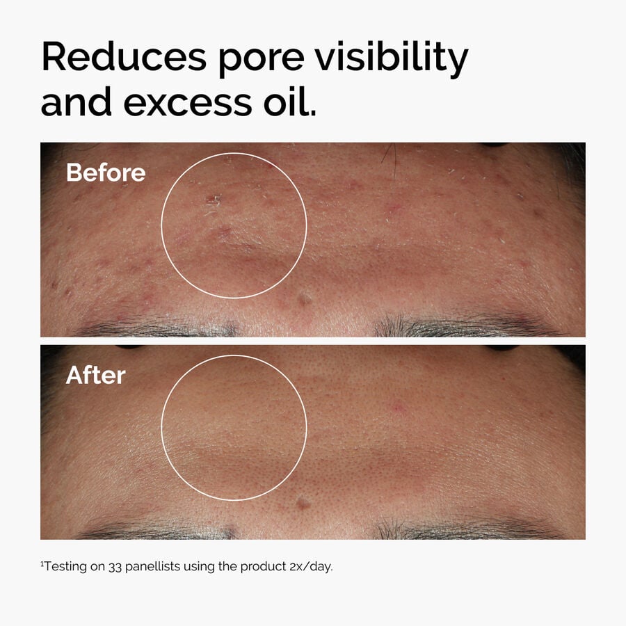 niacinamide-10-zinc-1-o3 ord-niacinamide-zinc-blemish-serum-before-after-pores.jpg