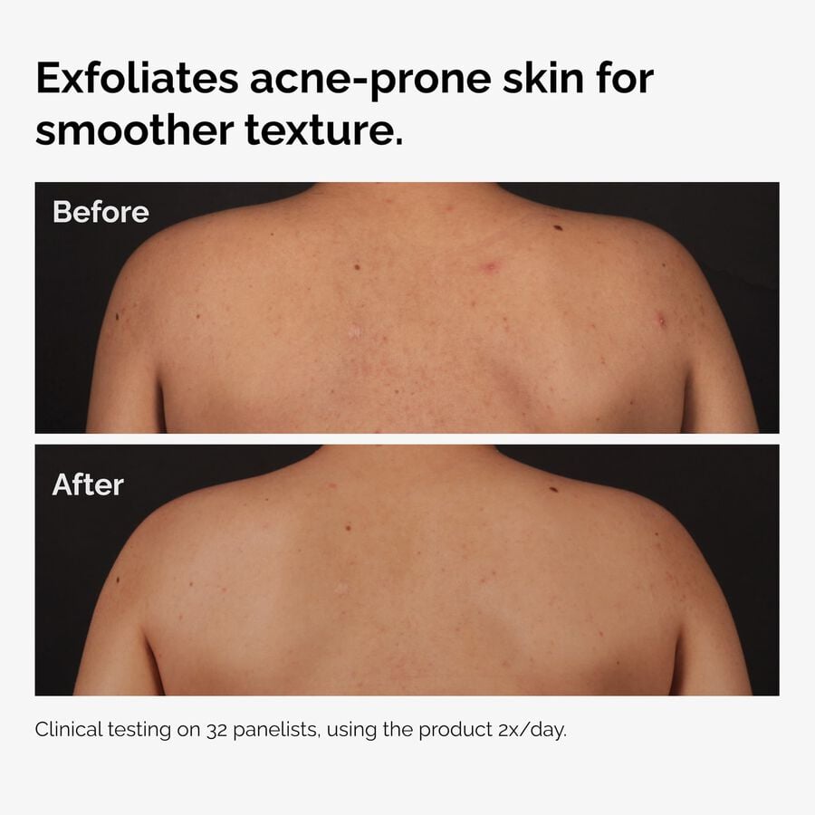 the-body-care-collection-h9 ord-salicylic-acid-body-serum-before-after-graphic-NA.jpg