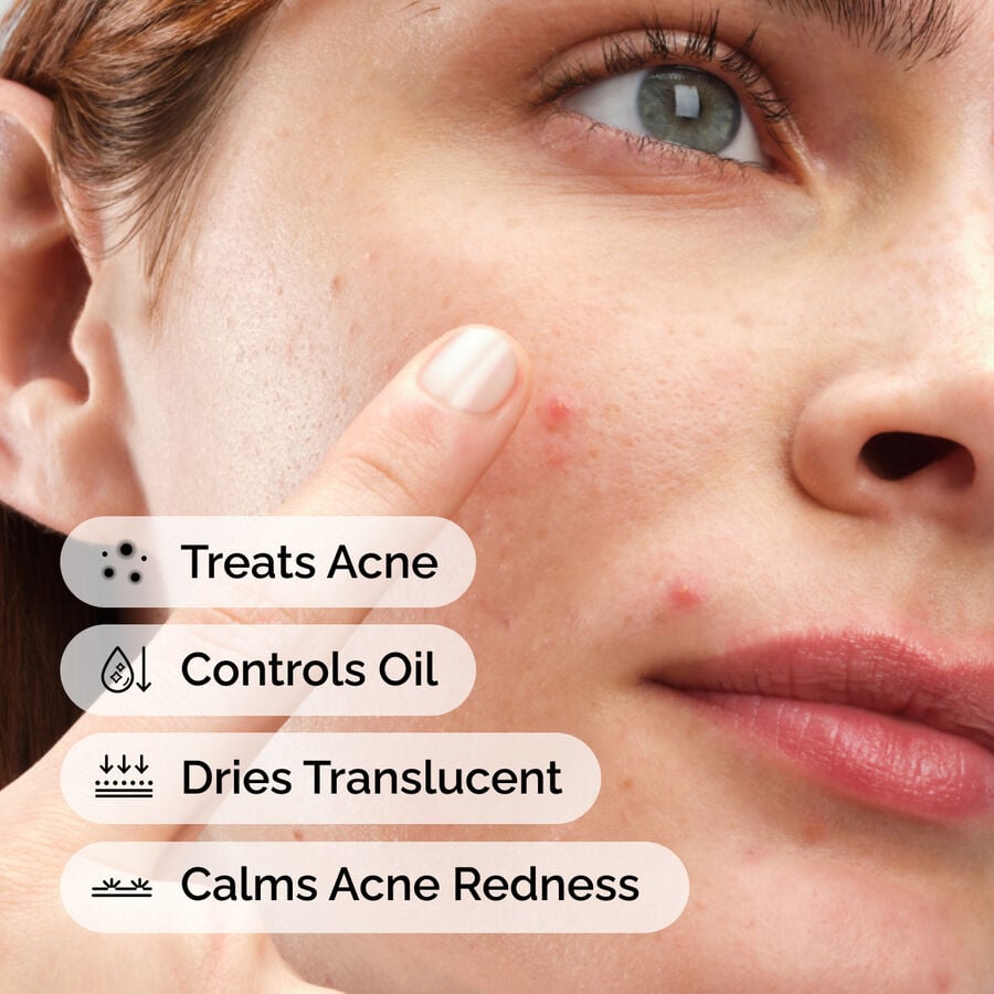 sulfur-10-powder-to-cream-concentrate-f0 ord-sulfur-10pct-powder-to-cream-concentrate-model-application-with-benefits-acne.jpg
